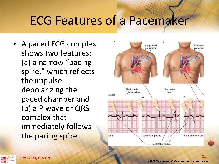 ECG Features of a Pacemaker • A paced ECG complex shows two features: (a)