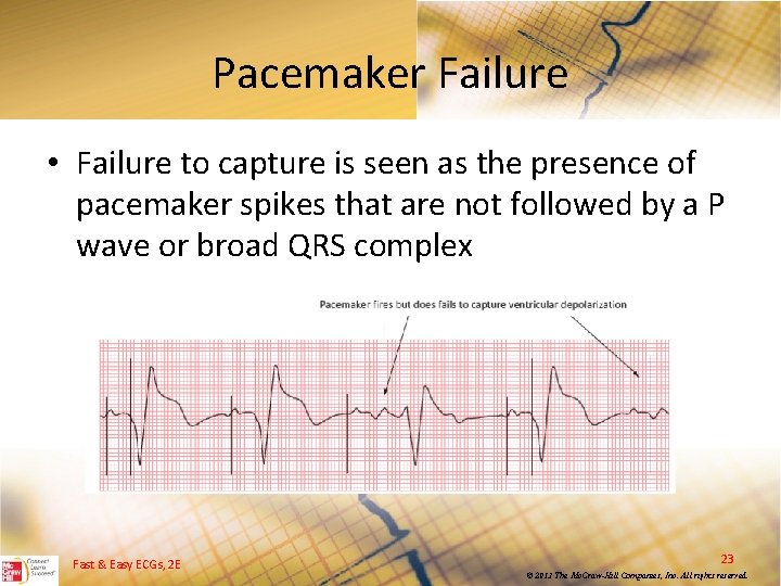 Pacemaker Failure • Failure to capture is seen as the presence of pacemaker spikes