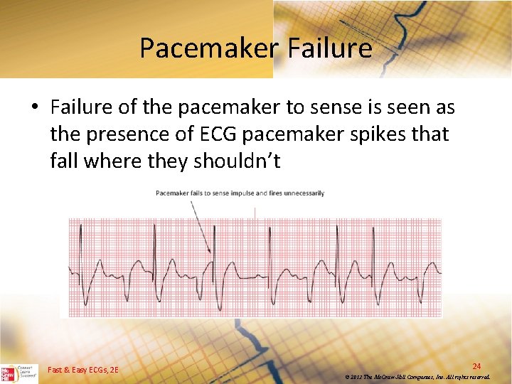 Pacemaker Failure • Failure of the pacemaker to sense is seen as the presence