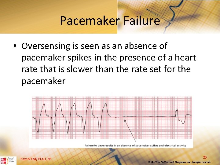Pacemaker Failure • Oversensing is seen as an absence of pacemaker spikes in the