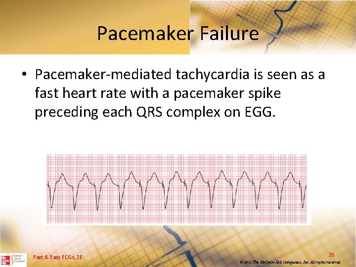 Pacemaker Failure • Pacemaker mediated tachycardia is seen as a fast heart rate with