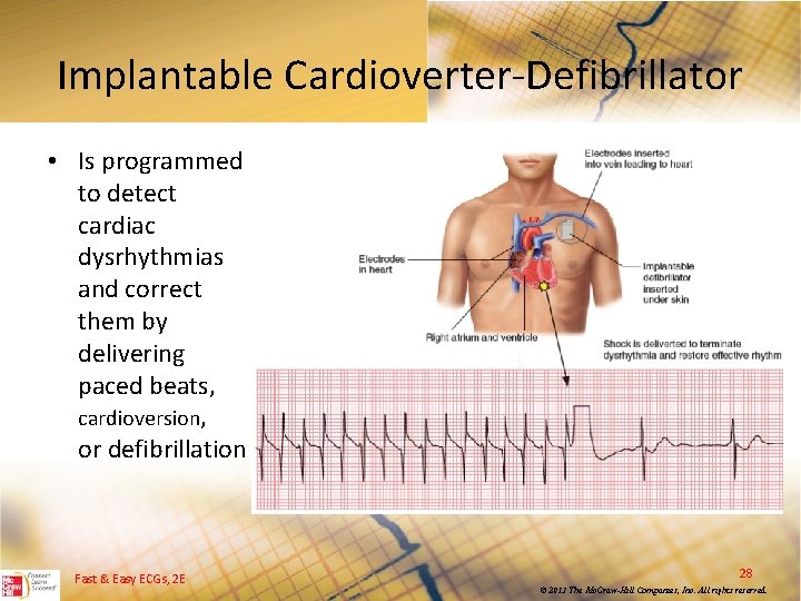 Implantable Cardioverter Defibrillator • Is programmed to detect cardiac dysrhythmias and correct them by