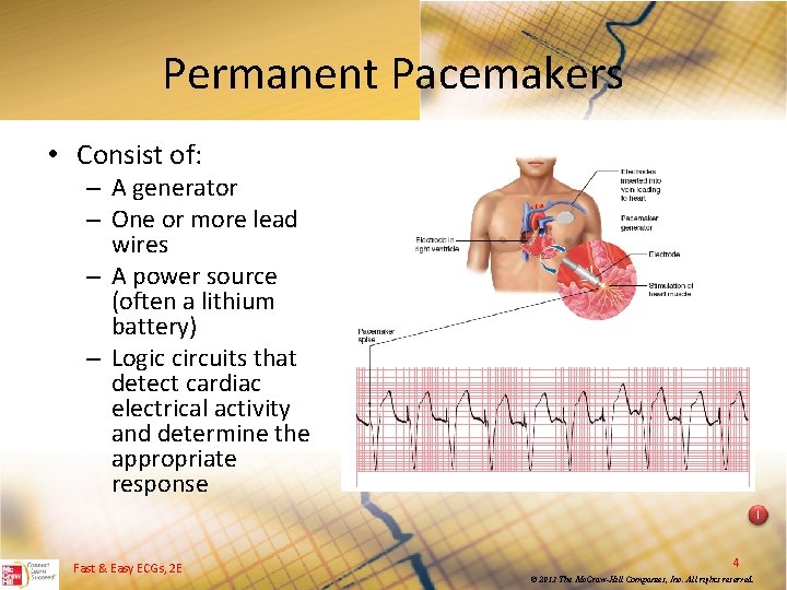 Permanent Pacemakers • Consist of: – A generator – One or more lead wires