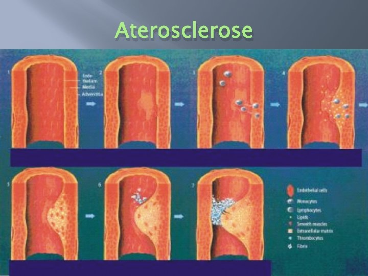 Aterosclerose 