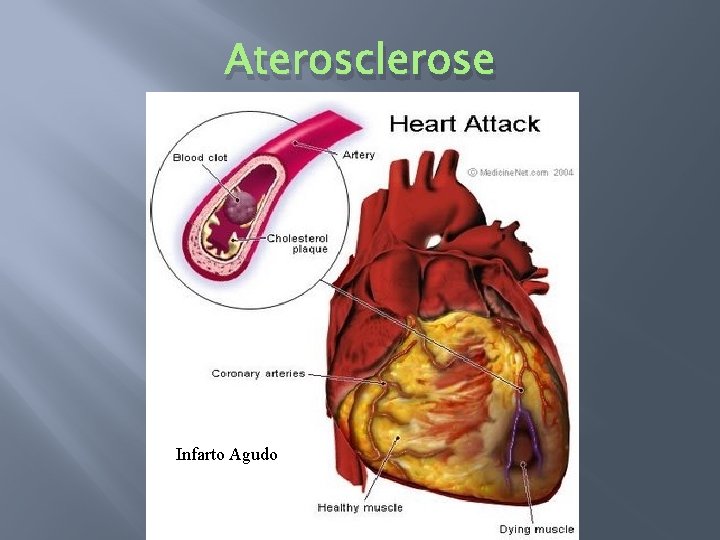 Aterosclerose Infarto Agudo 