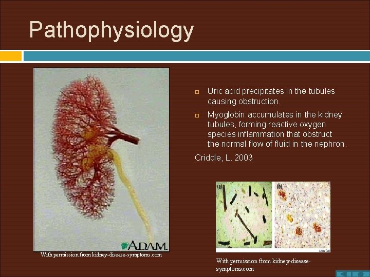 Pathophysiology Uric acid precipitates in the tubules causing obstruction. Myoglobin accumulates in the kidney