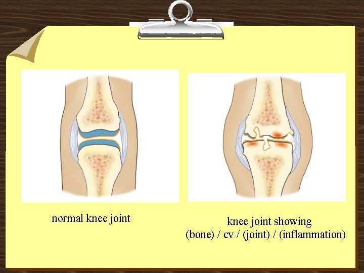 normal knee joint showing (bone) / cv / (joint) / (inflammation) 