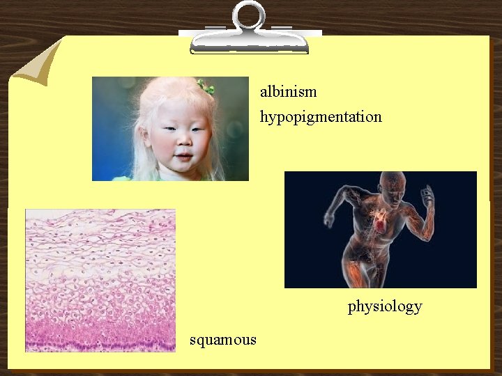 albinism hypopigmentation physiology squamous 