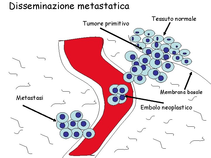 Disseminazione metastatica Tumore primitivo Metastasi Tessuto normale Membrana basale Embolo neoplastico 