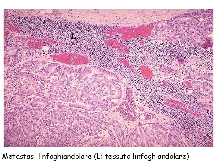 L Metastasi linfoghiandolare (L: tessuto linfoghiandolare) 