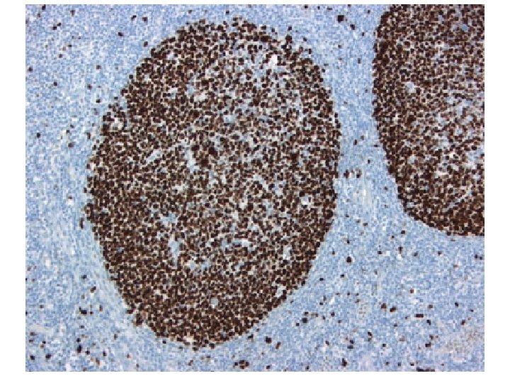 Iperplasia centri germinativi Linfoma nodulare Tumore benigno Anaplasia