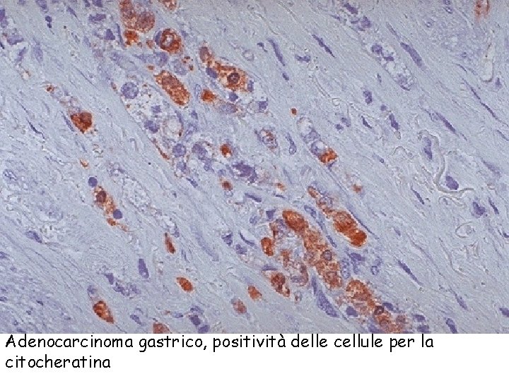 Adenocarcinoma gastrico, positività delle cellule per la citocheratina 