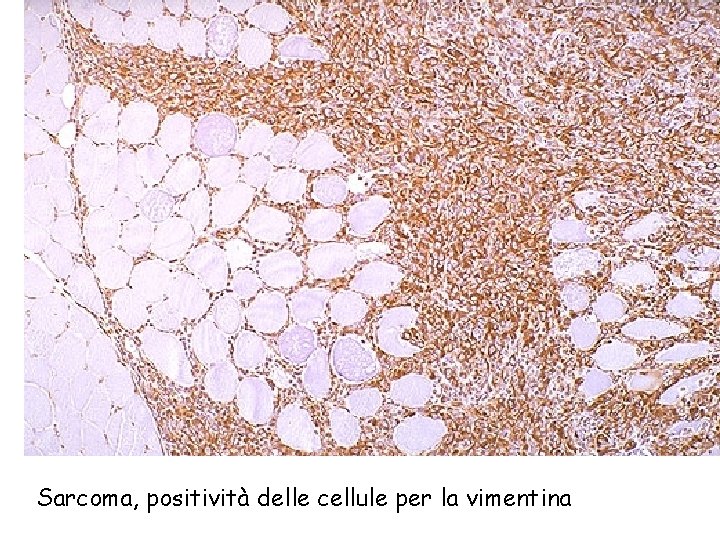 Sarcoma, positività delle cellule per la vimentina 