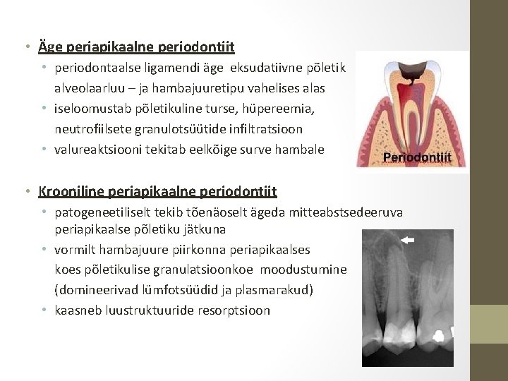  • Äge periapikaalne periodontiit • periodontaalse ligamendi äge eksudatiivne põletik alveolaarluu – ja