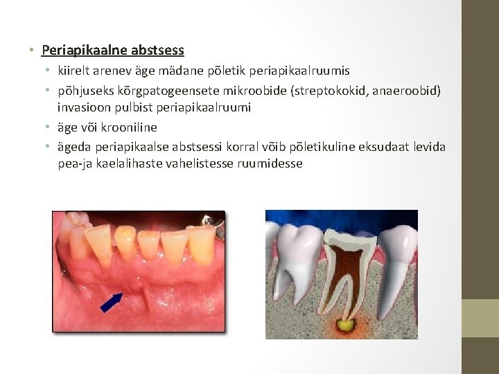  • Periapikaalne abstsess • kiirelt arenev äge mädane põletik periapikaalruumis • põhjuseks kõrgpatogeensete