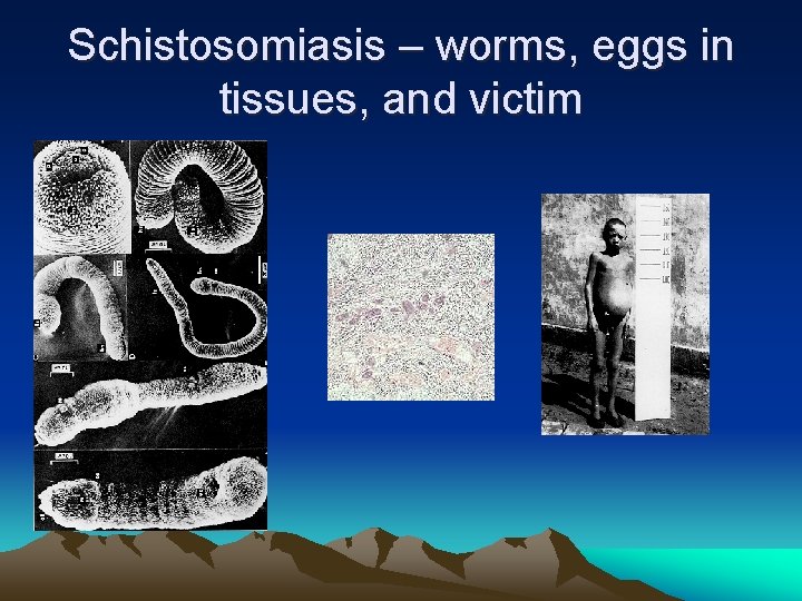 Schistosomiasis – worms, eggs in tissues, and victim 
