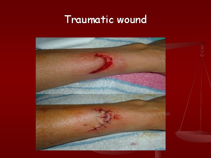 Traumatic wound 