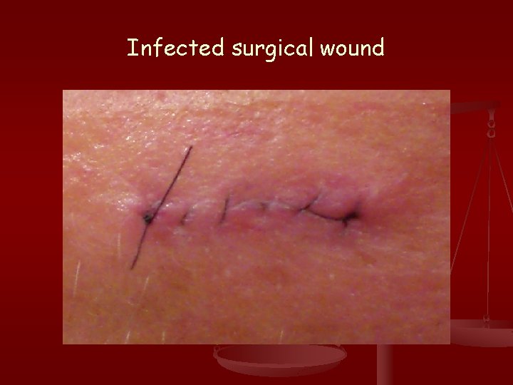 Infected surgical wound 