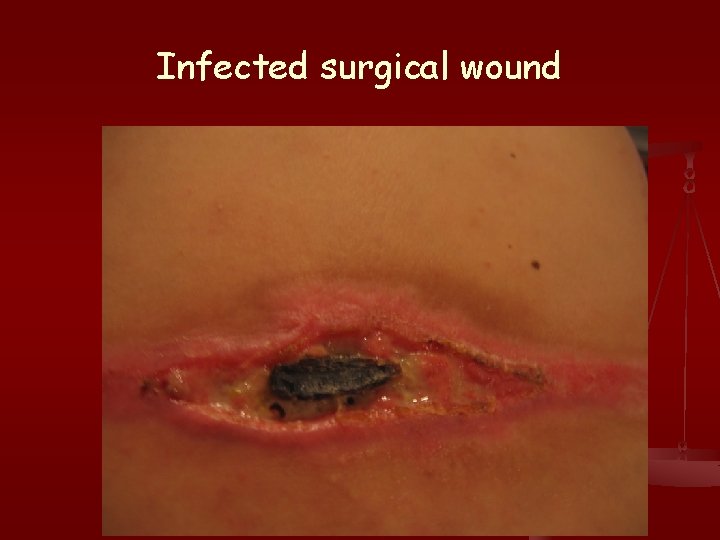 Infected surgical wound 