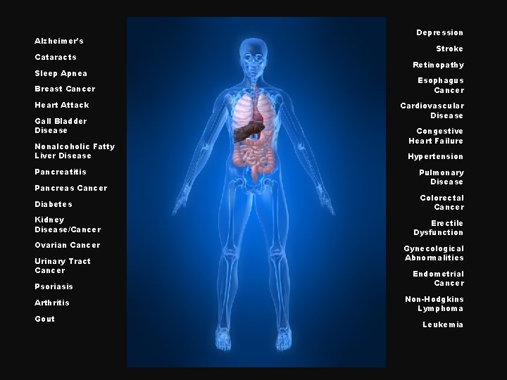 Alzheimer’s Cataracts Sleep Apnea Breast Cancer Heart Attack Gall Bladder Disease Nonalcoholic Fatty Liver