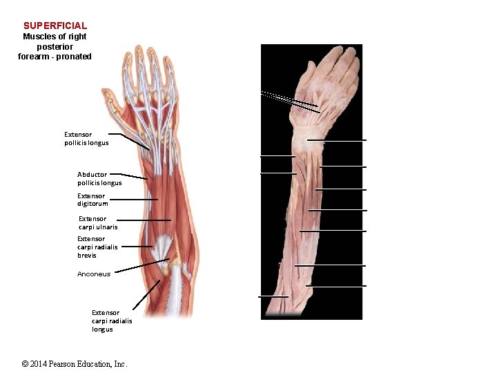 SUPERFICIAL Muscles of right posterior forearm - pronated Extensor pollicis longus Abductor pollicis longus
