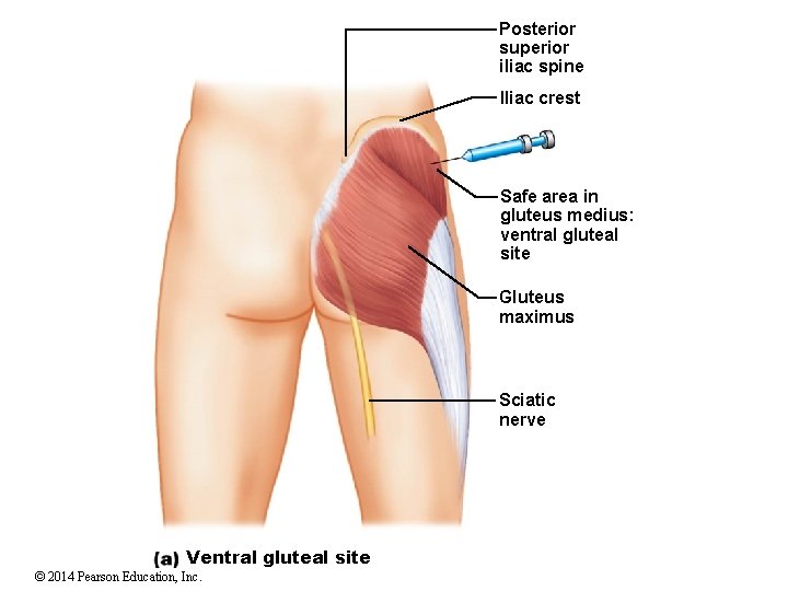 Posterior superior iliac spine Iliac crest Safe area in gluteus medius: ventral gluteal site
