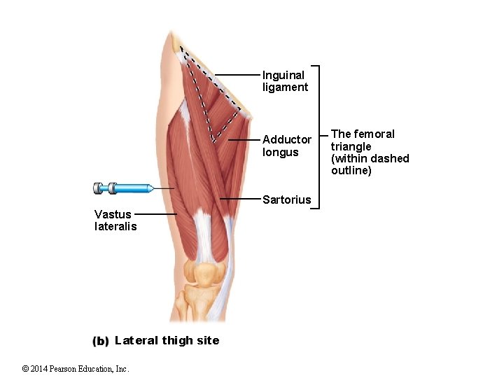 Inguinal ligament Adductor longus Sartorius Vastus lateralis Lateral thigh site © 2014 Pearson Education,