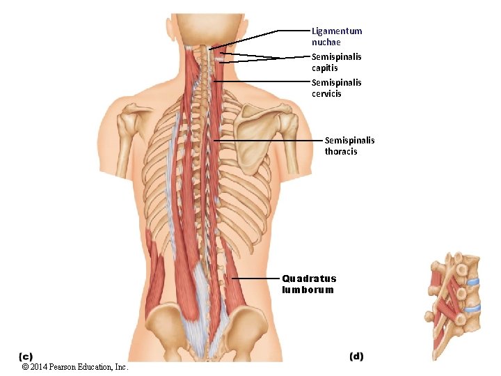 Ligamentum nuchae Semispinalis capitis Semispinalis cervicis Semispinalis thoracis Quadratus lumborum © 2014 Pearson Education,