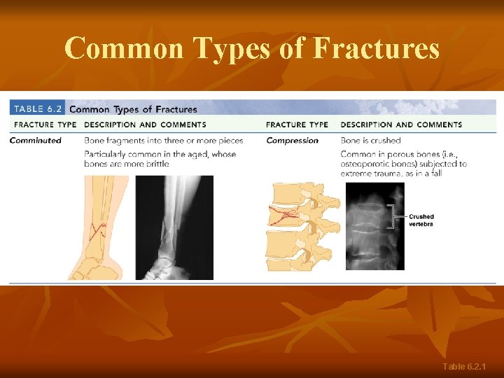 Common Types of Fractures Table 6. 2. 1 