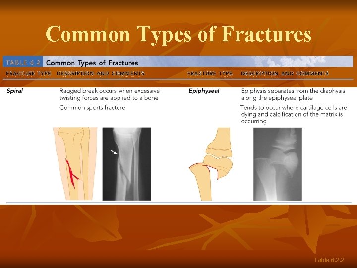 Common Types of Fractures Table 6. 2. 2 