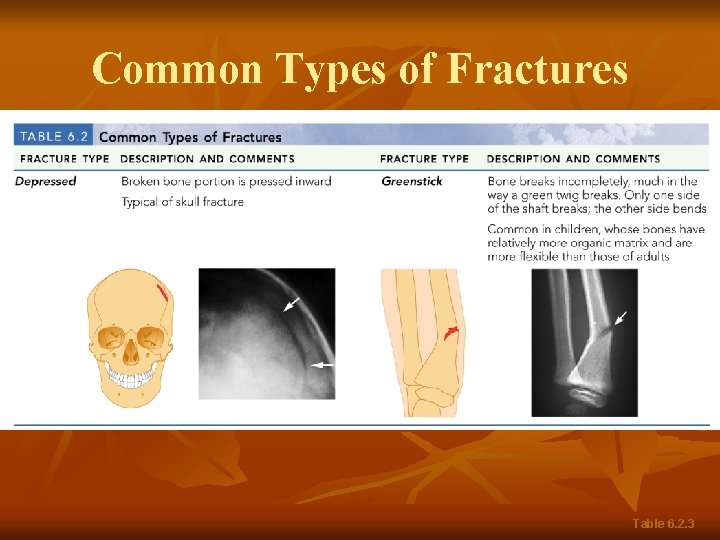 Common Types of Fractures Table 6. 2. 3 