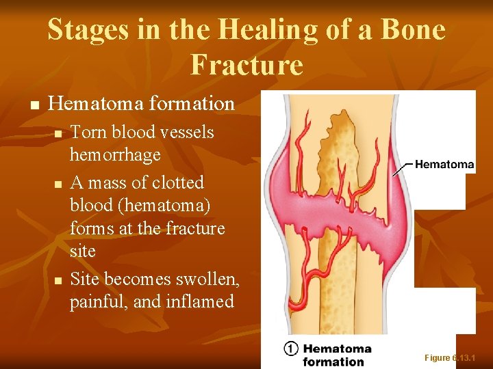 Stages in the Healing of a Bone Fracture n Hematoma formation n Torn blood