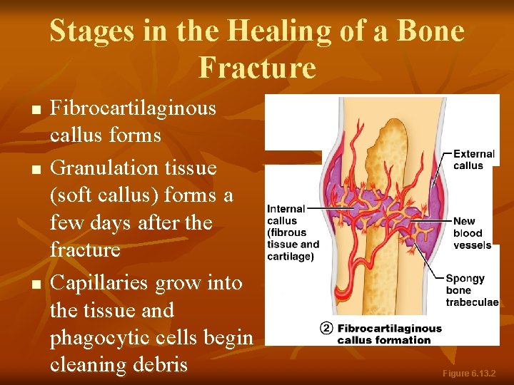 Stages in the Healing of a Bone Fracture n n n Fibrocartilaginous callus forms