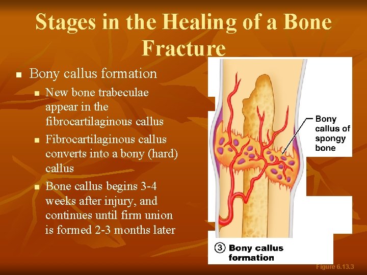 Stages in the Healing of a Bone Fracture n Bony callus formation n New