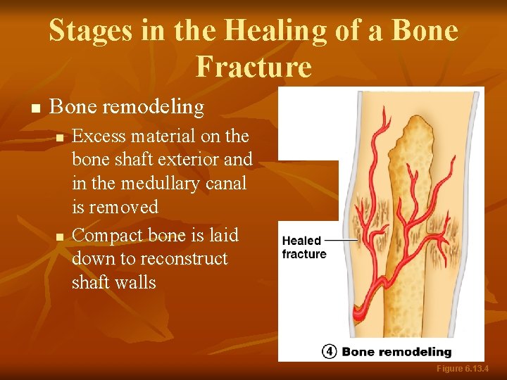 Stages in the Healing of a Bone Fracture n Bone remodeling n n Excess