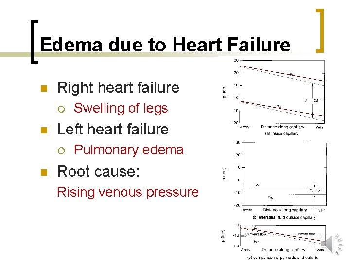 Edema due to Heart Failure n Right heart failure ¡ n Left heart failure