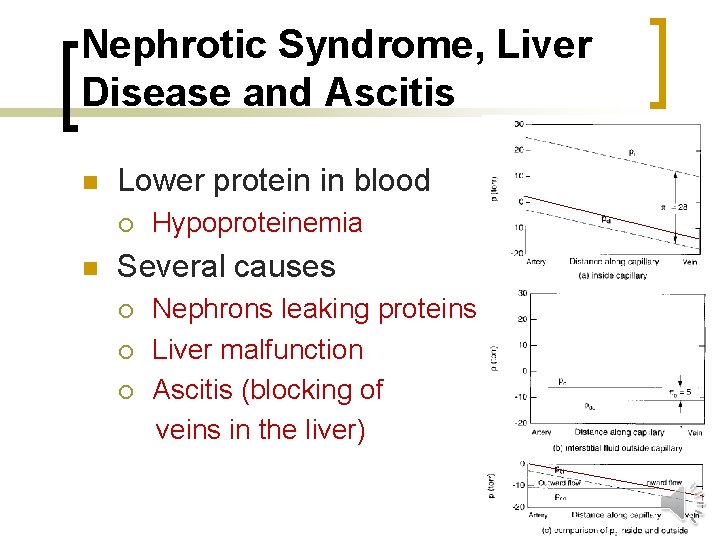 Nephrotic Syndrome, Liver Disease and Ascitis n Lower protein in blood ¡ n Hypoproteinemia
