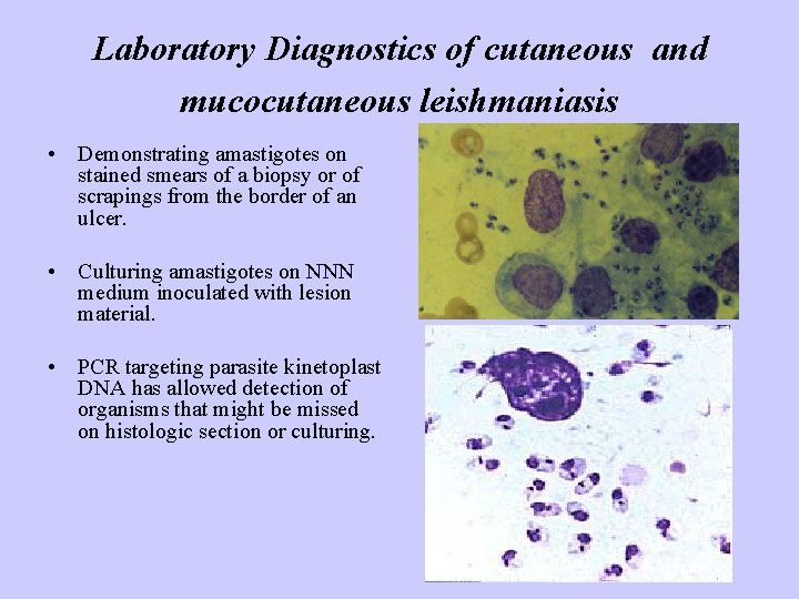 Laboratory Diagnostics of cutaneous and mucocutaneous leishmaniasis • Demonstrating amastigotes on stained smears of