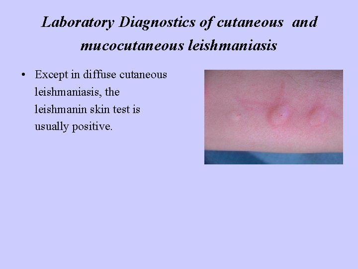 Laboratory Diagnostics of cutaneous and mucocutaneous leishmaniasis • Except in diffuse cutaneous leishmaniasis, the