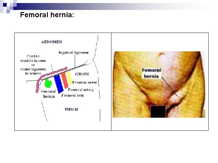 Femoral hernia: 