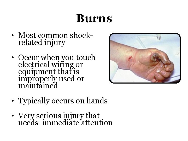 Burns • Most common shockrelated injury • Occur when you touch electrical wiring or