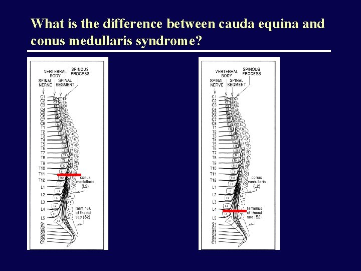 What is the difference between cauda equina and conus medullaris syndrome? 