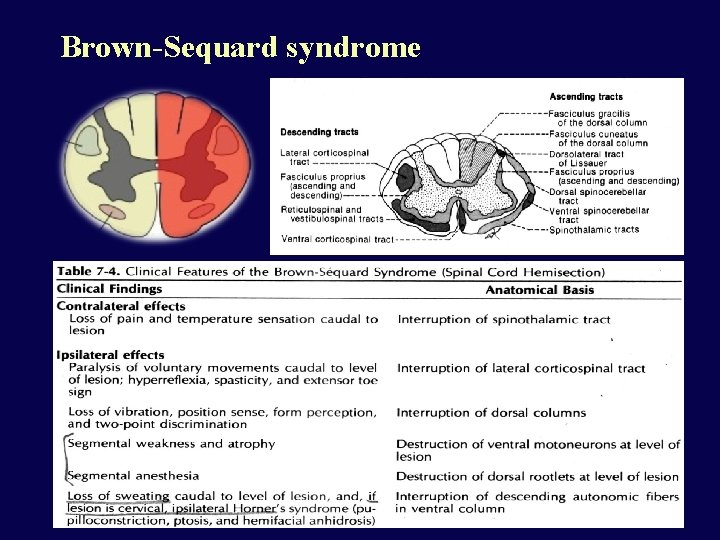 Brown-Sequard syndrome 