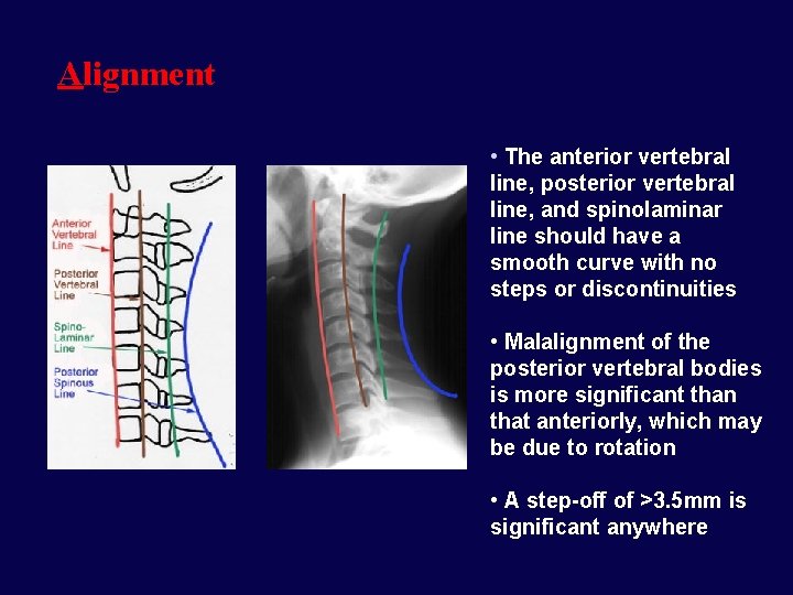 Alignment • The anterior vertebral line, posterior vertebral line, and spinolaminar line should have