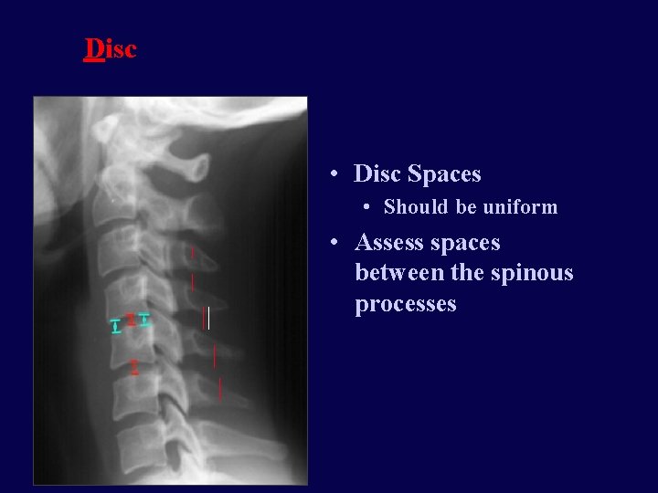 Disc • Disc Spaces • Should be uniform • Assess spaces between the spinous