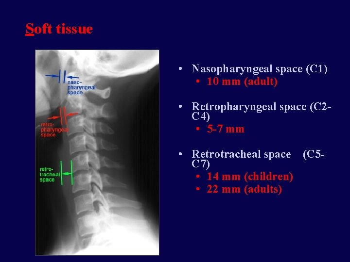 Soft tissue • Nasopharyngeal space (C 1) • 10 mm (adult) • Retropharyngeal space