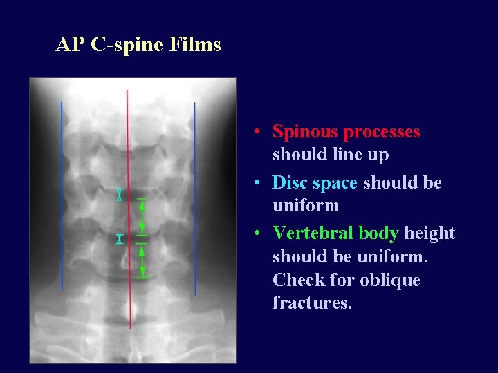 AP C-spine Films • Spinous processes should line up • Disc space should be