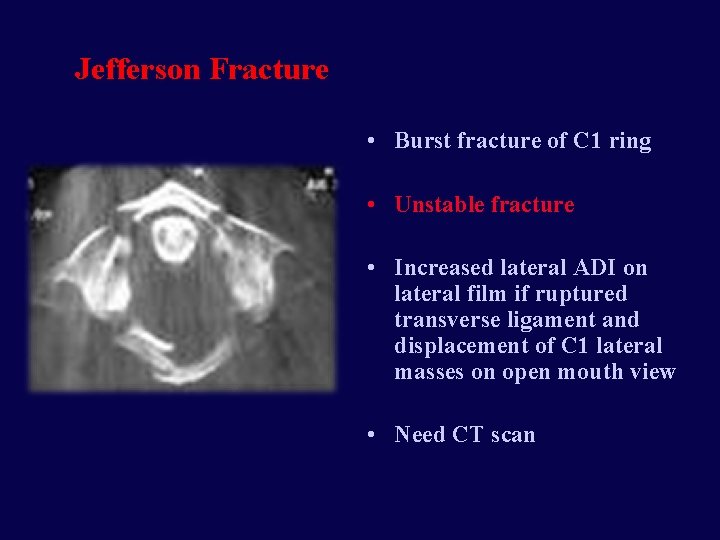 Jefferson Fracture • Burst fracture of C 1 ring • Unstable fracture • Increased