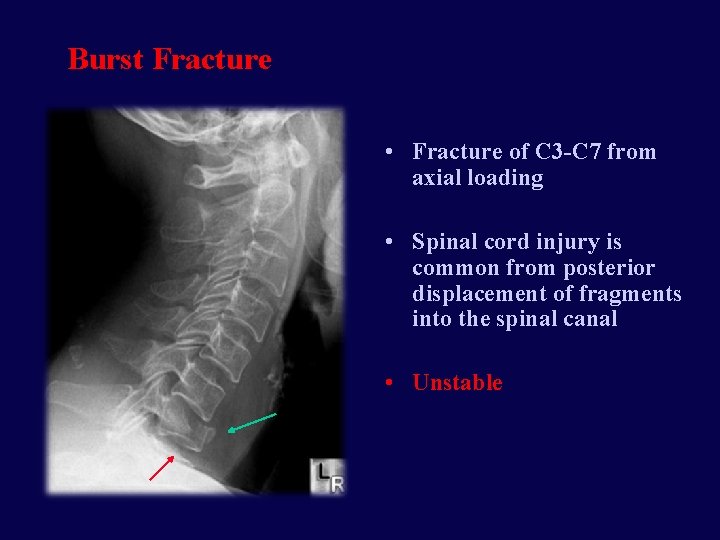 Burst Fracture • Fracture of C 3 -C 7 from axial loading • Spinal