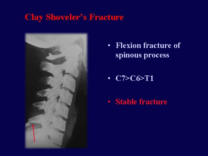 Clay Shoveler’s Fracture • Flexion fracture of spinous process • C 7>C 6>T 1